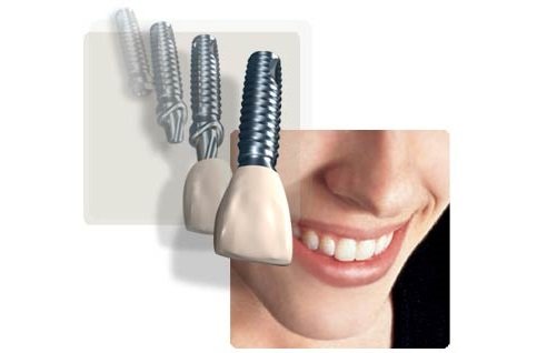 Elige un implante dental de calidad, resistente y duradero