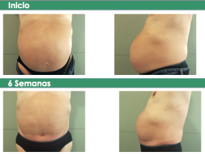 StopDiastasis.com_tripa con diástasis_antes y después